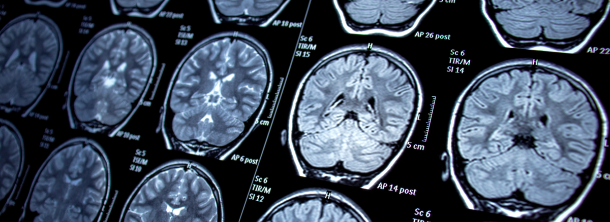 Epilepsi Nedir? Teşhis ve Tanı Yöntemleri Nelerdir?