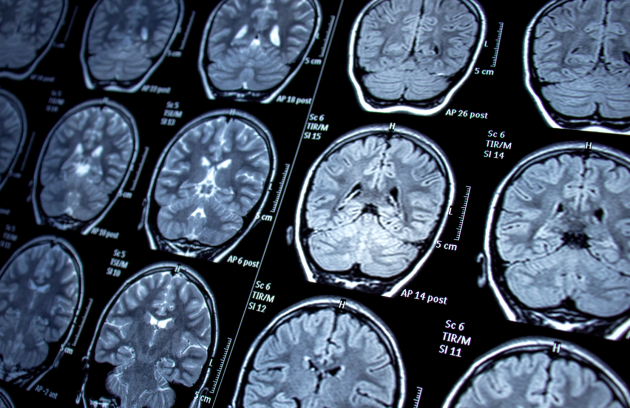 Epilepsi Nedir? Teşhis ve Tanı Yöntemleri Nelerdir?