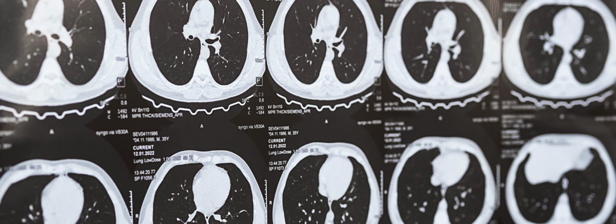 Akciğer Sertleşmesi (Pulmoner Fibrozis) Nedir? Teşhisi Nasıl Yapılır?