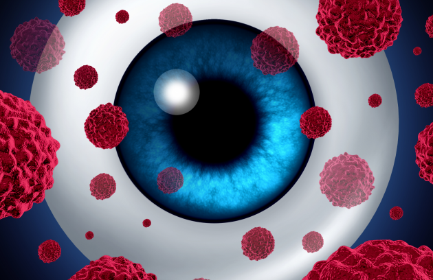 Oküler Melanom (Göz Melanomu) Nedir?