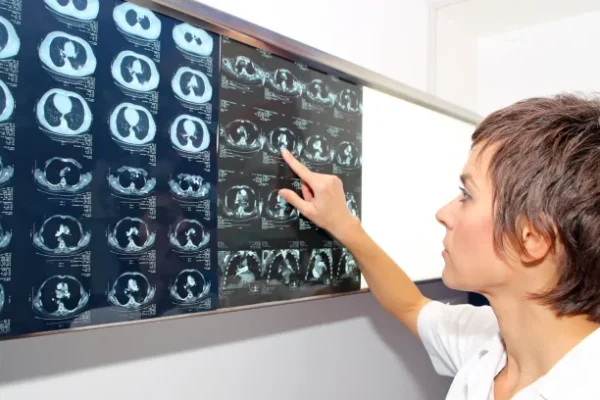 Akciğer Embolisi Nedir? Teşhis ve Tanı Yöntemleri Nelerdir?