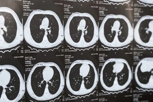 Akciğer Sertleşmesi (Pulmoner Fibrozis) Nedir? Teşhisi Nasıl Yapılır?