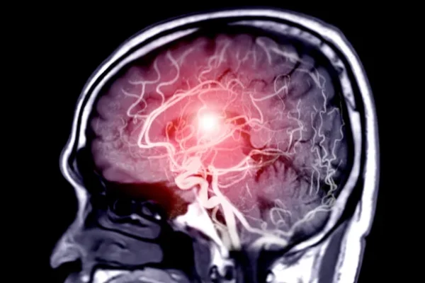 Anevrizma Nedir? Teşhis ve Tanı Yöntemleri Nelerdir?