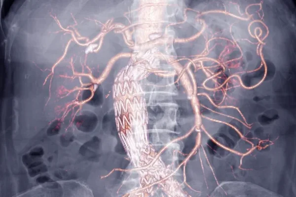 Aort Anevrizması Nedir? Teşhis ve Tanı Yöntemleri Nelerdir?