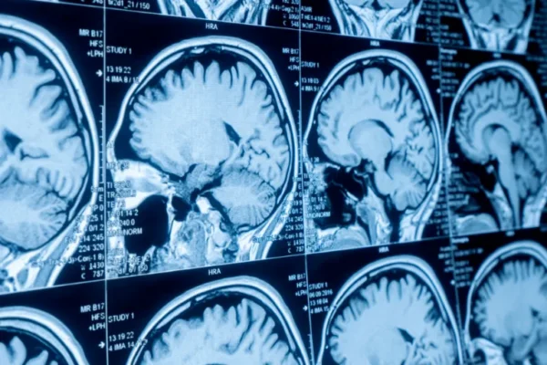 Beyin Emarı (Kranial MR)