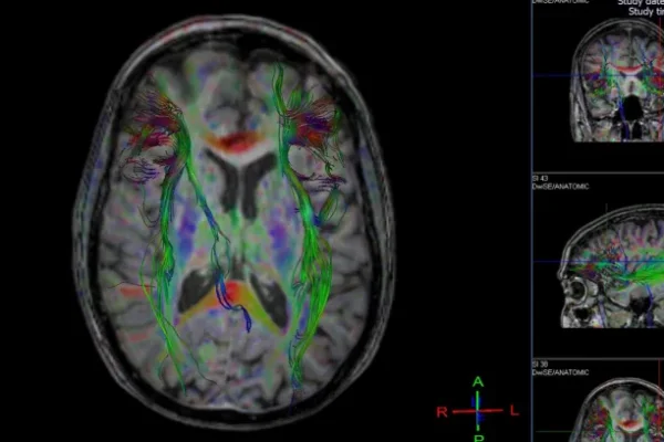 Beyin Haritalama Nedir? Nasıl Yapılır?