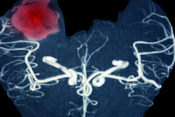 Beyin Kanaması Nedir? Teşhis ve Tanı Yöntemleri Nelerdir?