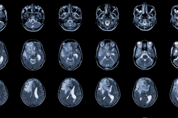 Beyin Ödemi Nedir? Tanı ve Teşhisi Nasıl Yapılır?