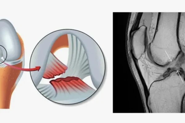 Çapraz Bağ Yırtığı Nedir? Tanı Yöntemleri Nelerdir?