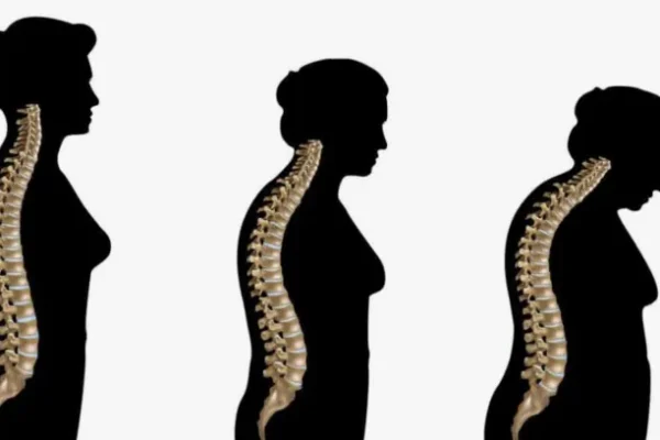 Bel Düzleşmesi Nedir?