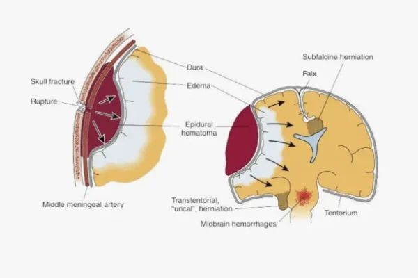 Epidural Hematom Nedir?