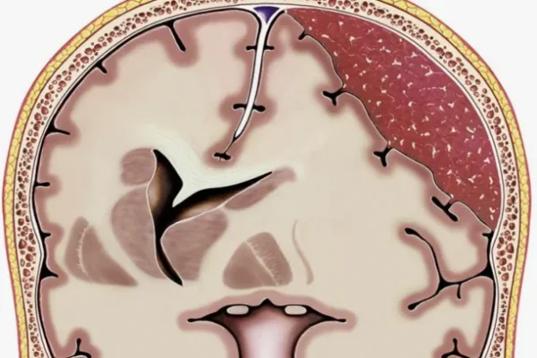 Subdural Hematom Nedir?