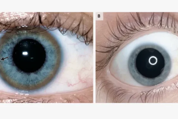 Wilson Hastalığı Nedir?