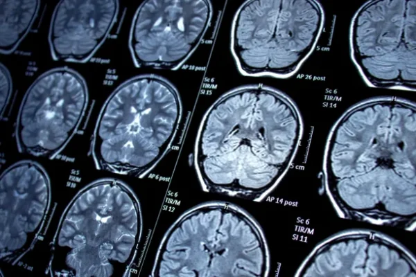 Epilepsi Nedir? Teşhis ve Tanı Yöntemleri Nelerdir?