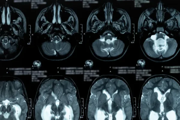 Hidrosefali Nedir? Belirtileri ve Tanı Yöntemleri Nelerdir?