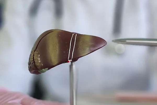 Karaciğer Biyopsisi