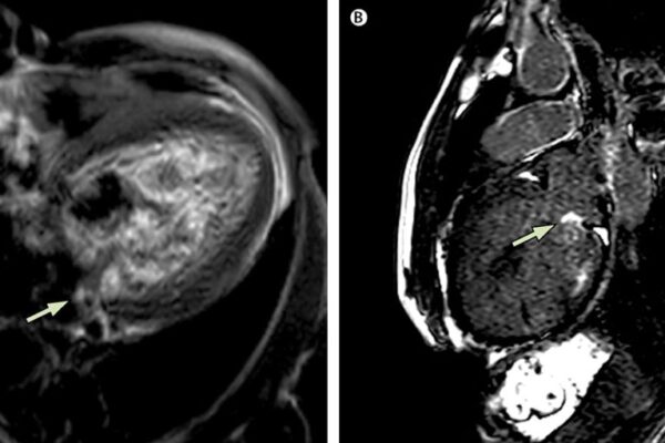 Kardiyak Emar (Kardiyak MR)