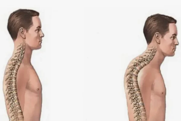 Kifoz (Kamburluk) Nedir?