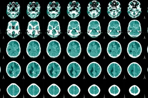 Menenjit Nedir? Teşhis ve Tanı Yöntemleri Nelerdir?