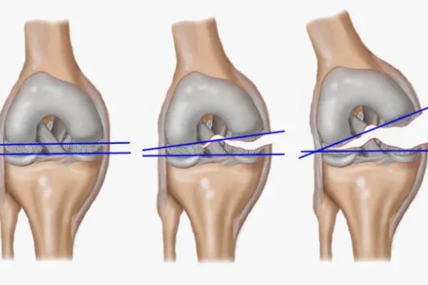 Menisküs Nedir? Tanı Yöntemleri Nelerdir?