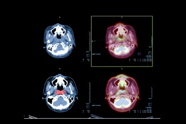 Nazofarenks Tomografisi