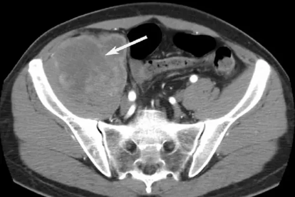 Pelvik Emar (Pelvik MR)
