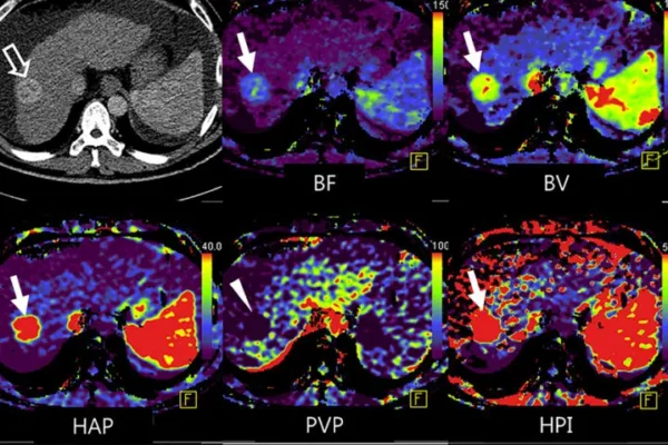 Perfüzyon Emar (Perfüzyon MR)