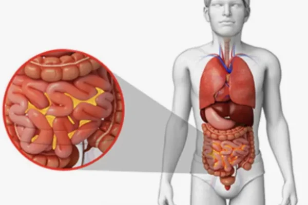Peritonit (Batın İçi Enfeksiyon) Nedir?