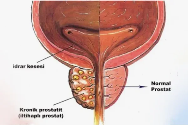 Prostat Nedir? Tanı Yöntemleri Nelerdir?