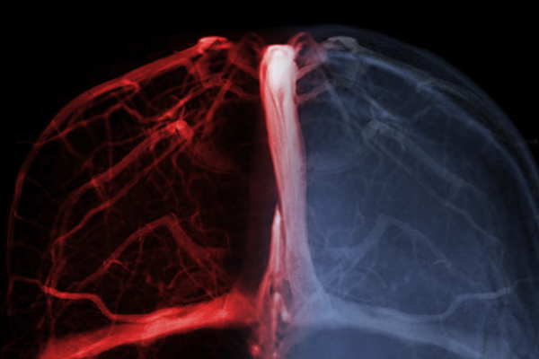 Serebral Ven Trombozu Nedir? Teşhis Yöntemleri Nelerdir?