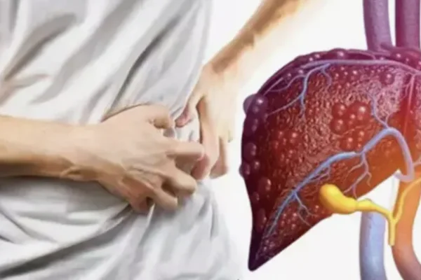 Siroz Nedir? Tanı Yöntemleri Nelerdir?