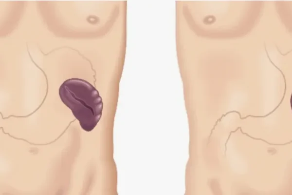 Dalak Büyümesi Nedir?