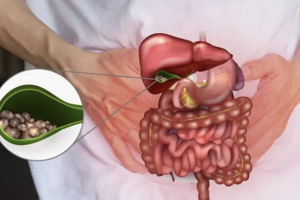 Safra Kesesi Taşı Nedir?