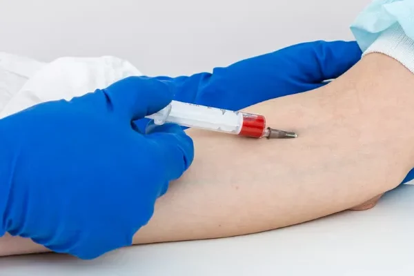 Chemoembolization